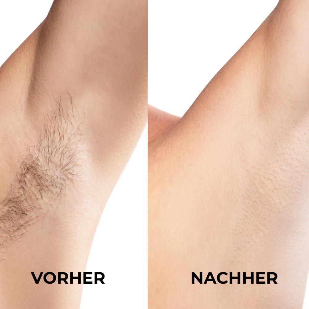 SKINGLIDE™ – Für Haut, die sich wie Seide anfühlt - Sag Tschüss zu Rasierpickeln, Stoppeln & Hautstress